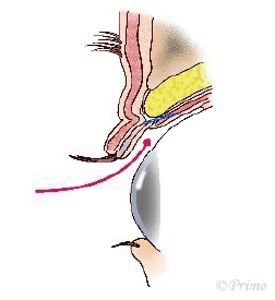 経結膜眼瞼下垂手術イラスト